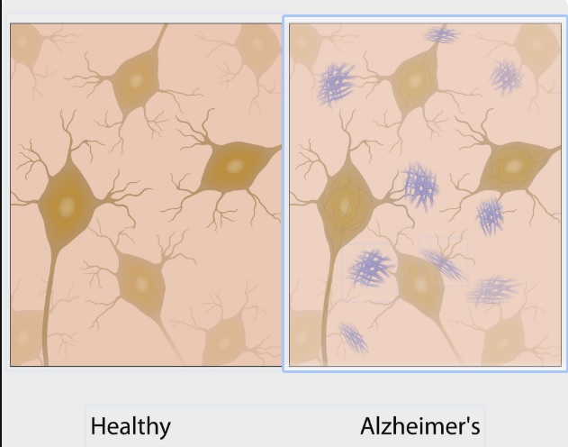 Infográfico comparativo sobre Alzheimer: imunoterapia do Instituto Weizmann, proteína Tau e mielina, e mapeamento genético do Instituto Allen.