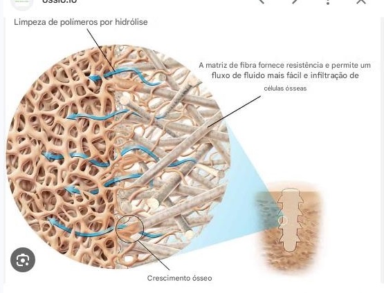 Implantes ortopédicos BioGlass Ossio tecnologia israelense.